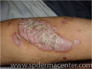 Psoriasis-Before